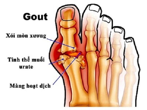 gout-megumiha-990-vien-cua-nhat-ho-tro-benh-gout